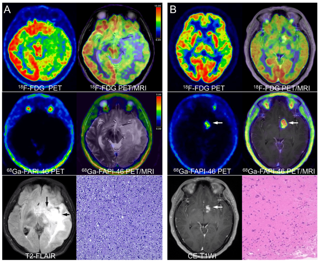 新基因检测方法可在2小时内诊断脑肿瘤