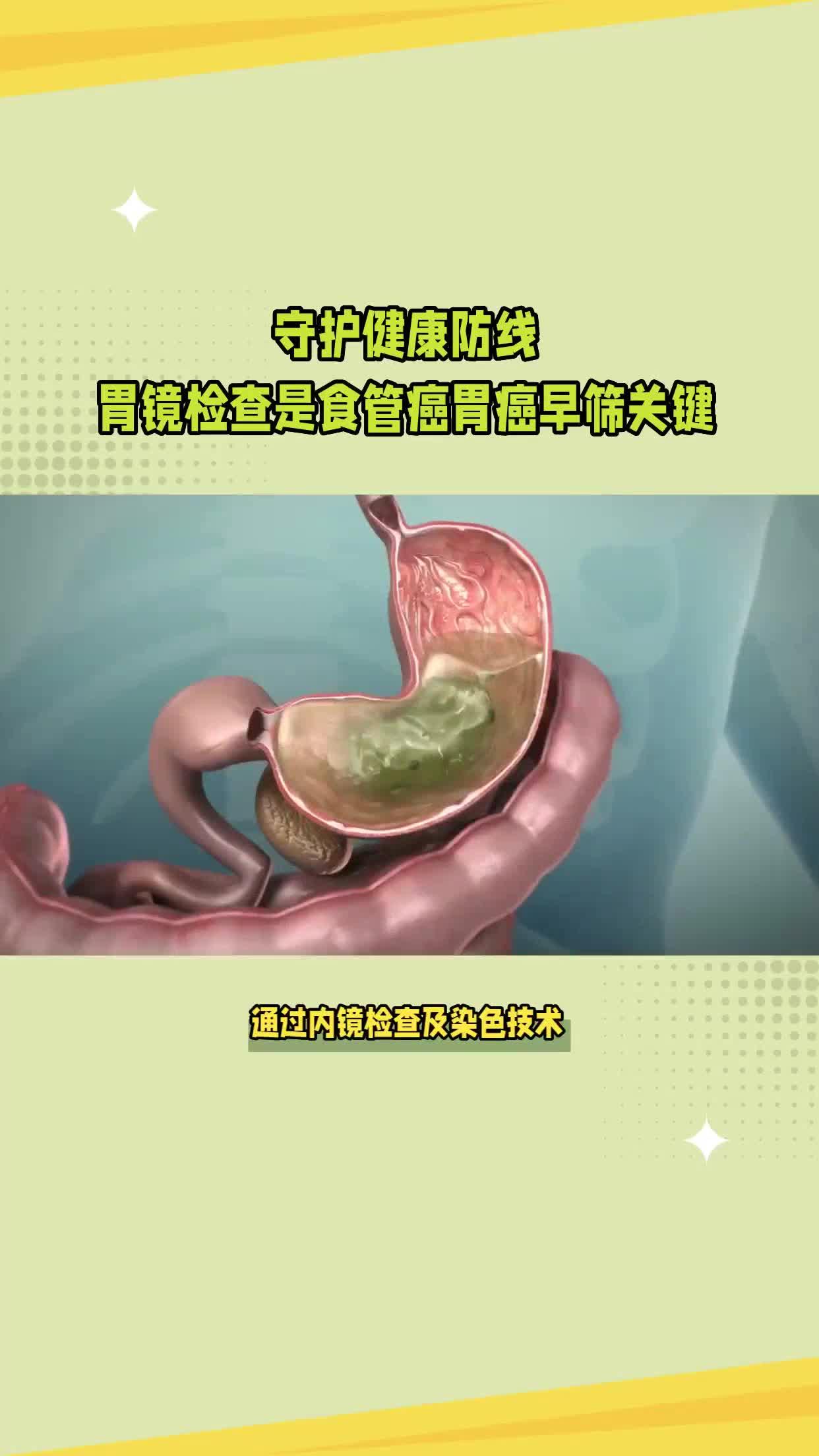 胃癌筛查困局有望破解：AI影像分析推动胃癌早筛智能发展